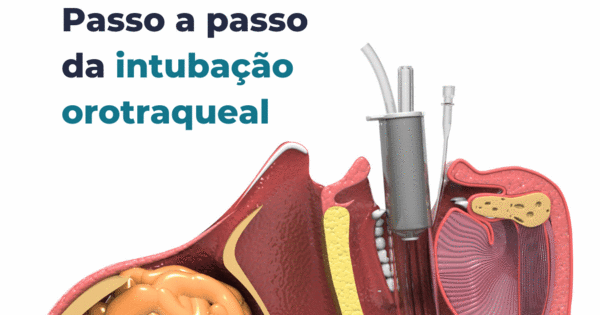 Passo a passo da intubação orotraqueal Academia Médica