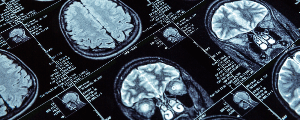 Neurocovid: 80% dos pacientes hospitalizados tem dano neurológico