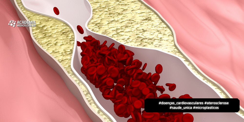 Pesquisa Liga Microplásticos à Progressão da Aterosclerose