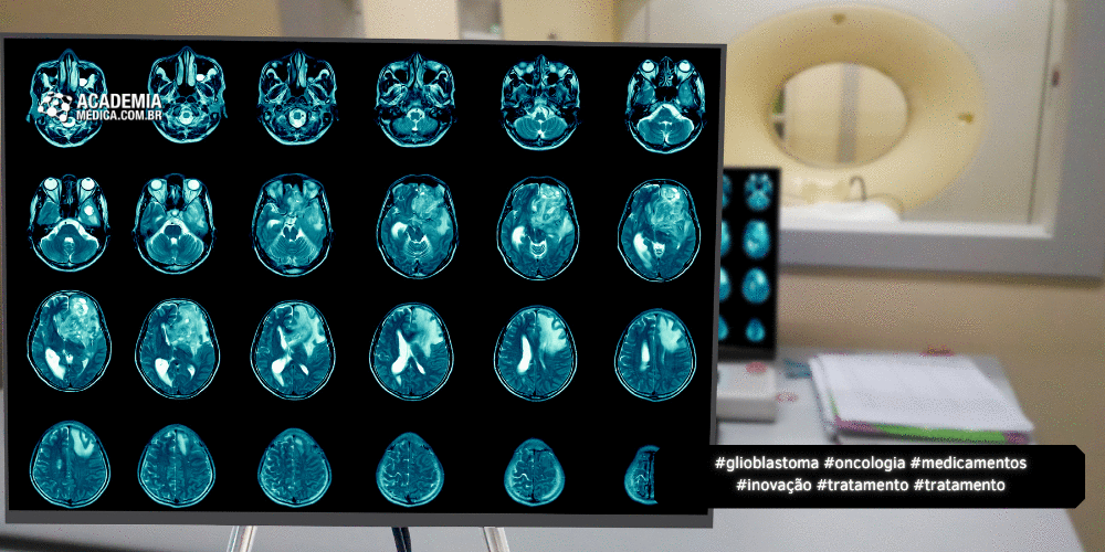 Medicamento Inovador Pode Dobrar Sobrevida de Pacientes com Glioblastoma