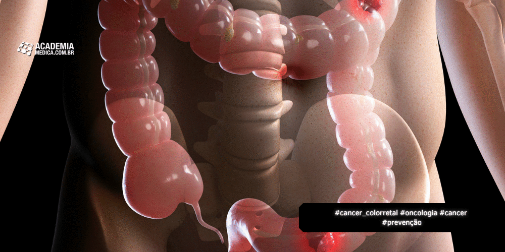 Alta do Câncer Colorretal Antes dos 50 Alerta e Reforça a Detecção Precoce