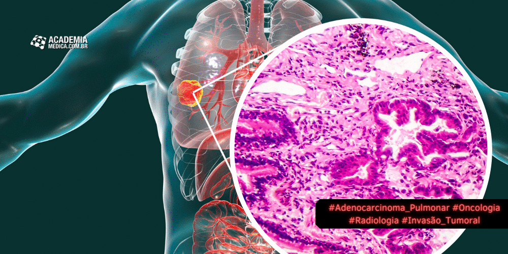 Adenocarcinoma pulmonar: Radiologia na detecção de invasão tumoral