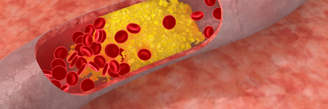 Novo tratamento demonstra eficácia na redução dos níveis de lipídeos no sangue