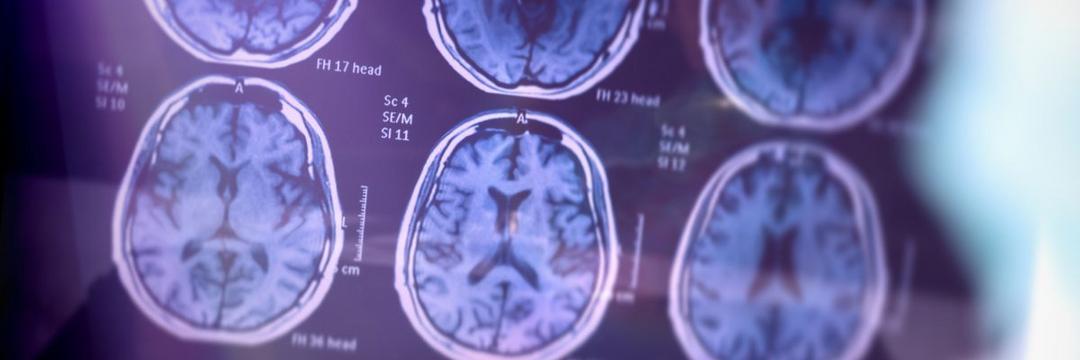 Demência: sinais de comprometimento cerebral podem ser identificados anos antes do diagnóstico 