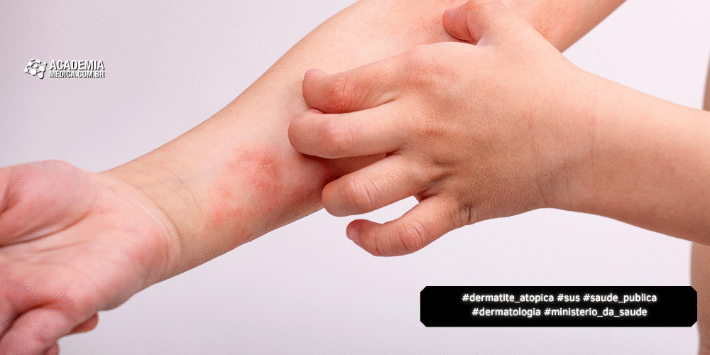 SUS Amplia Cuidados com Dermatite Atópica com Novas Terapias 