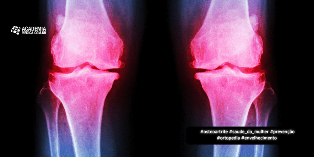 Aumento da Osteoartrite em Mulheres Pós-Menopausa