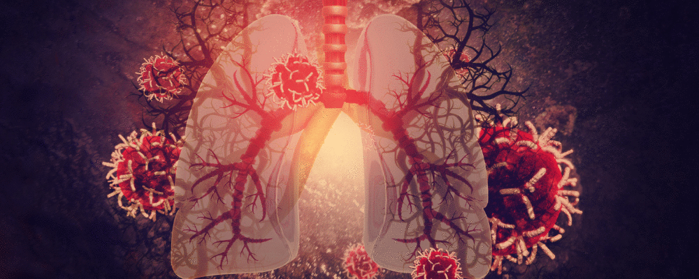 Diagnóstico e tratamento da síndrome da angústia respiratória aguda