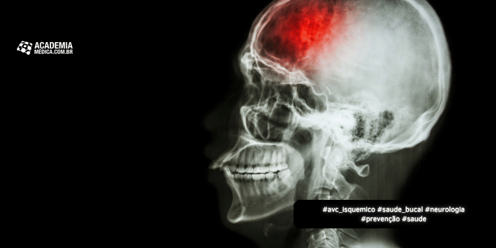 Saúde bucal e AVC: o Que Revela um Estudo de 20 Anos