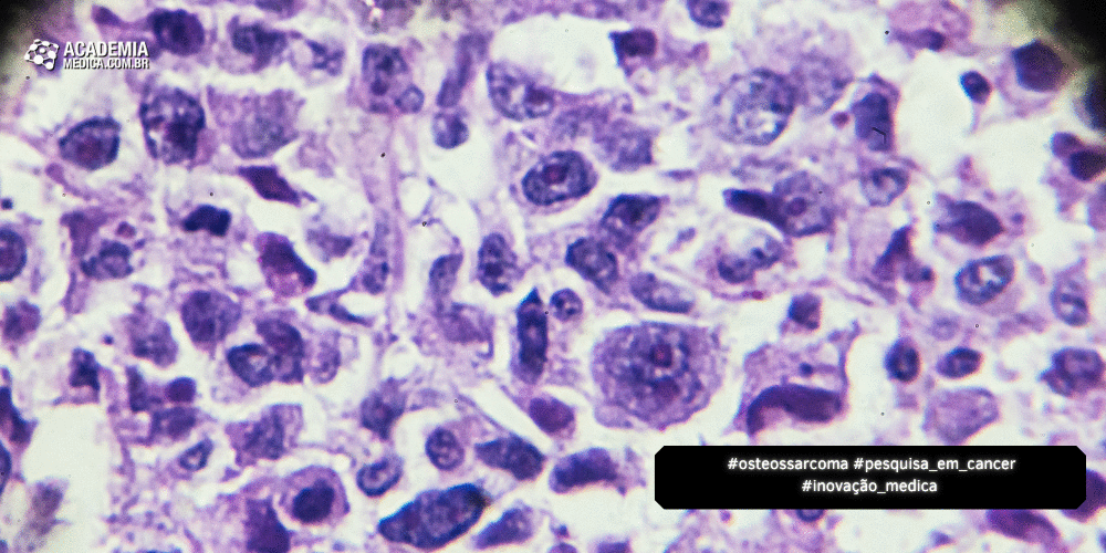 Estudo Inova no Diagnóstico e Tratamento de Osteossarcoma