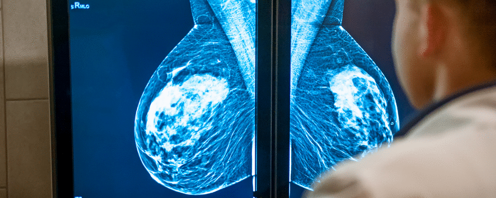 Como rastrear o câncer de mama?