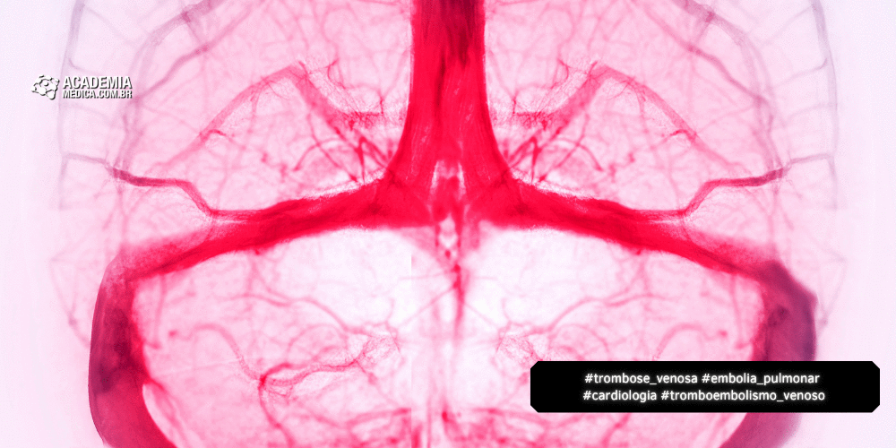 Ferramenta Eletrônica Permite Monitorar Diagnósticos Tardios de Trombose Venosa