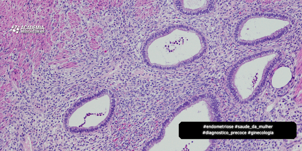 Novos Horizontes no Diagnóstico Precoce da Endometriose