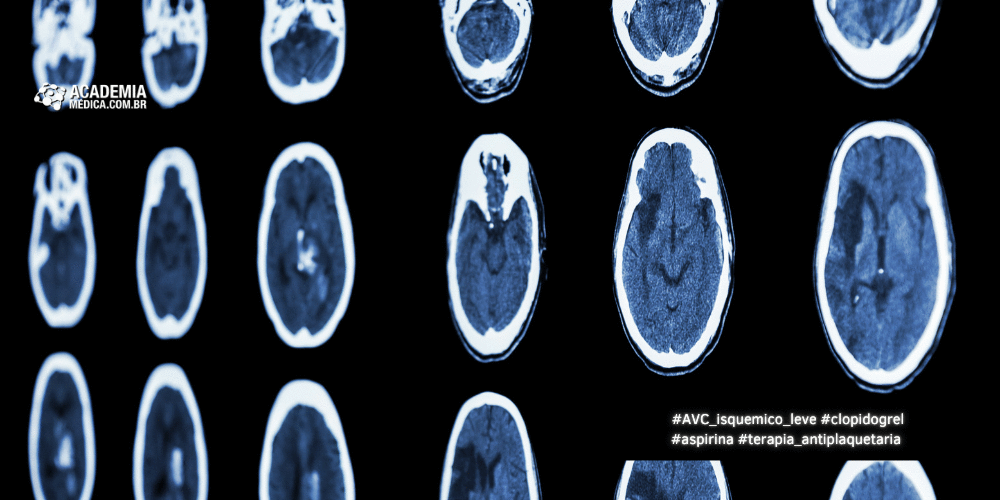 Terapia Antiplaquetária Pós-AVC Isquêmico Leve com Clopidogrel e Aspirina