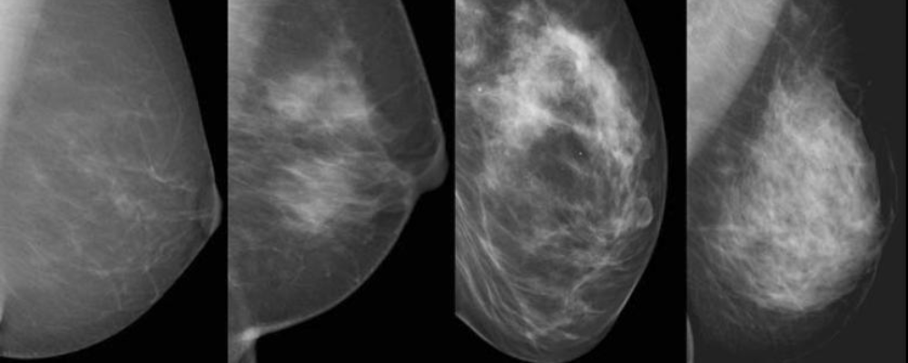 Densidade da mama e percepção do risco de câncer entre mulheres