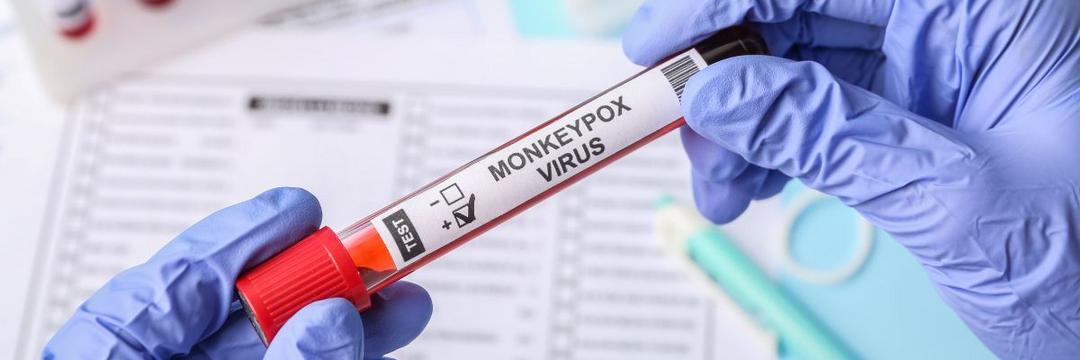 Estudo sugere que monkeypox é transmitida principalmente antes do aparecimento de sintomas