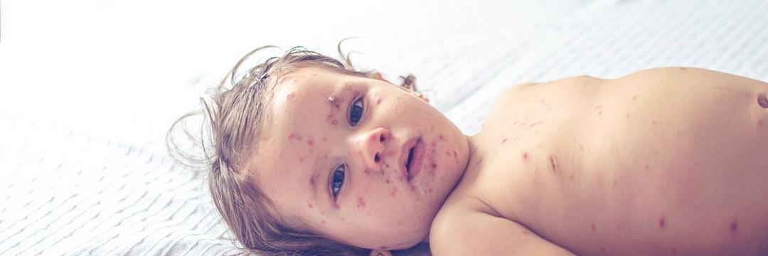 Surto de sarampo atinge crianças pequenas nos Estados Unidos