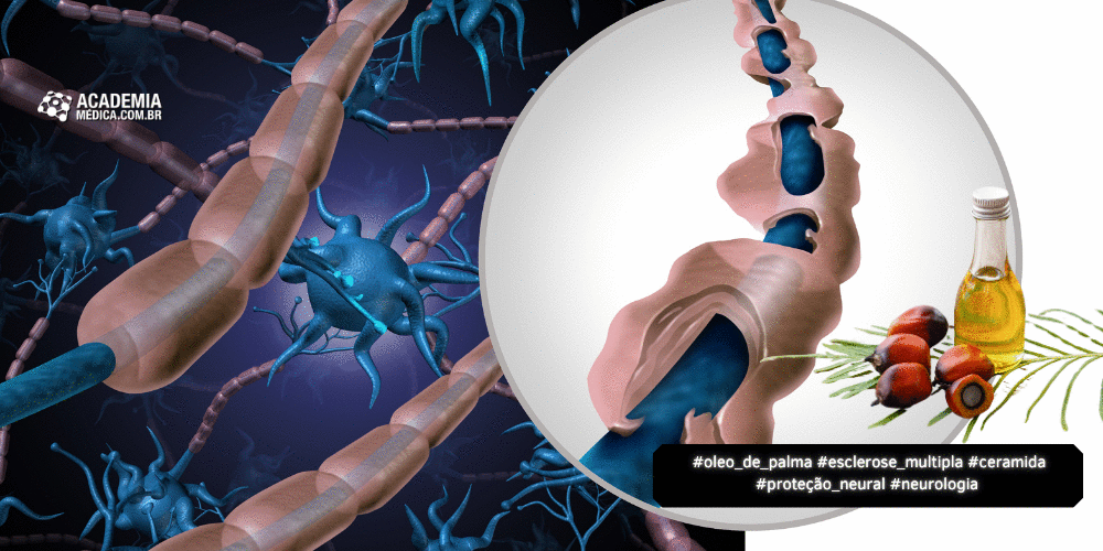 Dieta Rica em Óleo de Palma Pode Agravar Progressão da Esclerose Múltipla, Revela Estudo