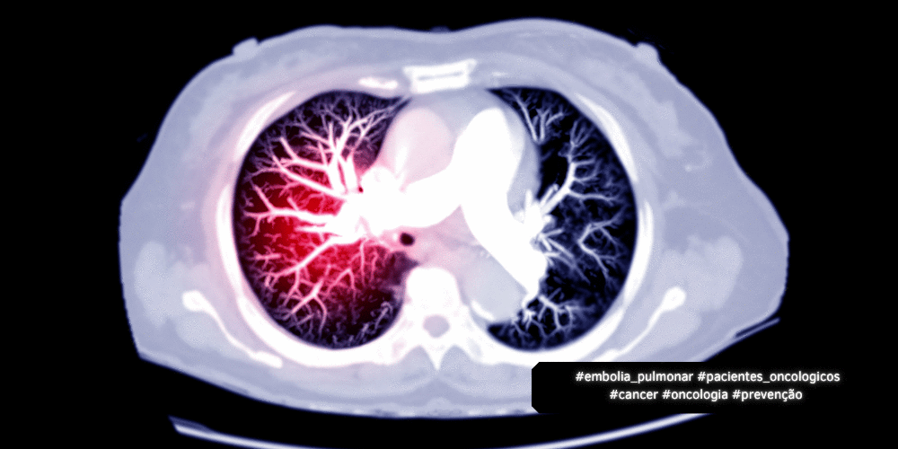 Taxas de Mortalidade por Embolia Pulmonar em Pacientes com Câncer