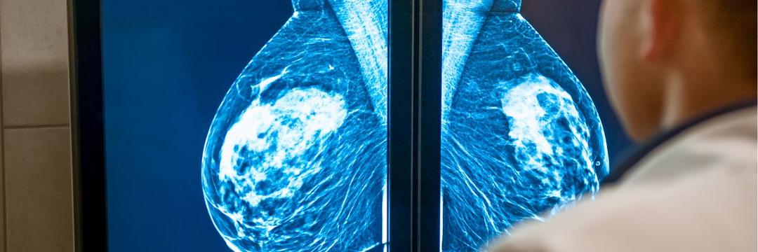 Outubro Rosa! Brasil registra queda no número de mamografias