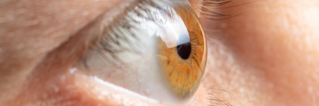 Lente de contato monitora pressão intraocular e faz aplicação de medicamento para controle do glaucoma