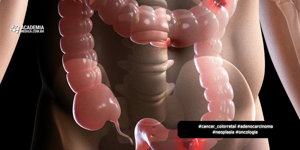 Entendendo o Aumento do Câncer Colorretal Precoce