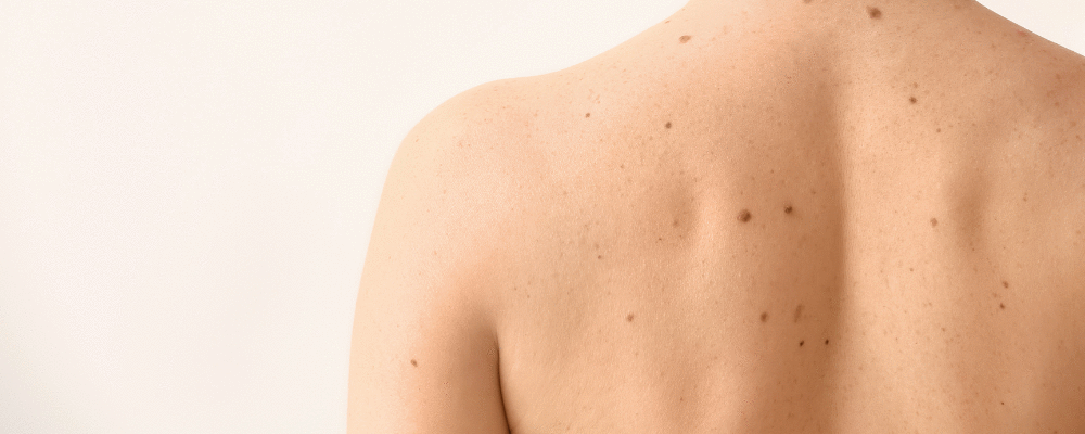 Nivolumabe e Pembrolizumabe agora estão disponíveis no SUS para o tratamento de câncer de pele