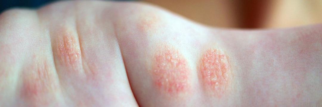 Crianças com dermatite atópica têm maior risco de sofrer fratura subsequente