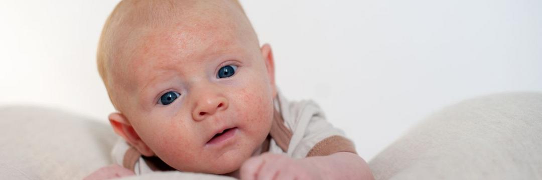Saiba qual a melhor estratégia para combater a dermatite atópica em bebês