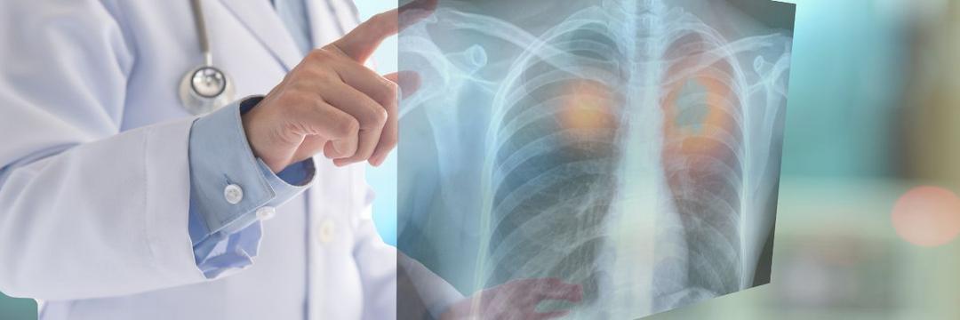FDA aprova uso de novo agente de imagem para remoção de câncer de pulmão