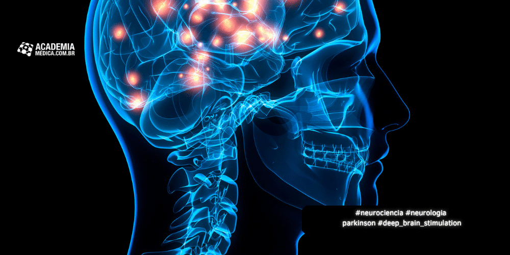 Implantes Cerebrais Inteligentes Inauguram Nova Era no Tratamento do Parkinson