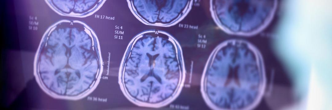 Idosos têm mais riscos de desenvolver Alzheimer após infecção por Covid-19