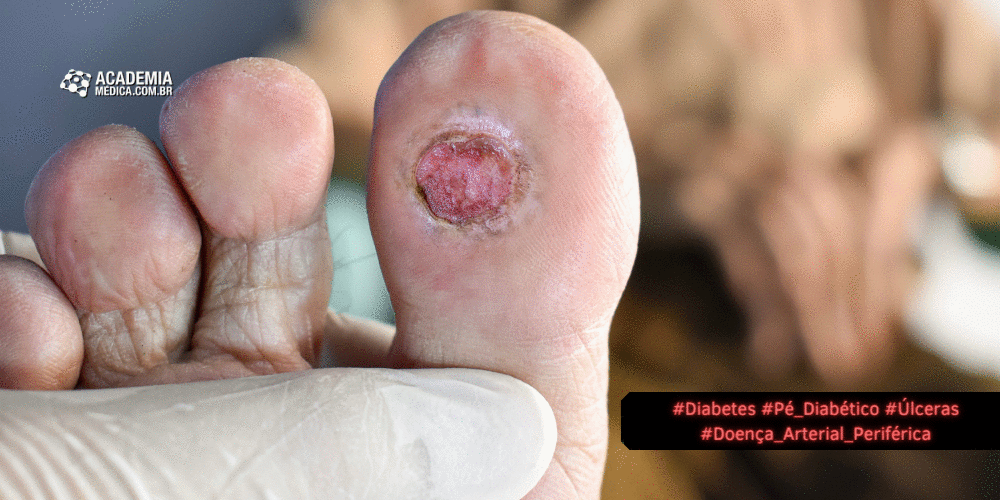 Úlcera do pé diabético: Um desafio crítico no manejo do diabetes