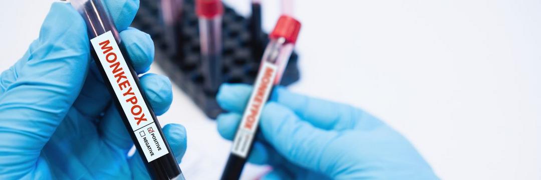 Saiba quais são os Lacens habilitados para realizar teste diagnóstico para varíola dos macacos