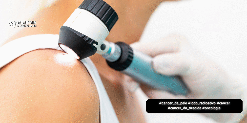 Vigilância Dermatológica é Recomendada para Pacientes Tratados com Iodo Radioativo